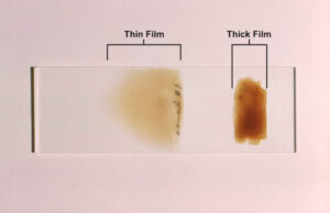 Casos de malaria en EE. UU. desatan comentarios falsos sobre vínculos con investigación financiada por Gates Casos de malaria en Estados Unidos