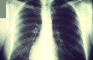 Video afirma falsamente que 850 personas murieron de miocarditis en México Radiografía que muestra el estado del cuerpo ante la muerte por miocarditis.