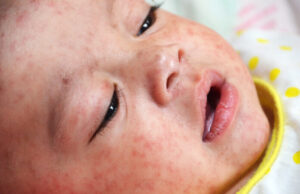 Una inyección protege a los bebés de la hospitalización por VRS, no se la ha relacionado con muertes Bebé sujeto a tratamiento VRS