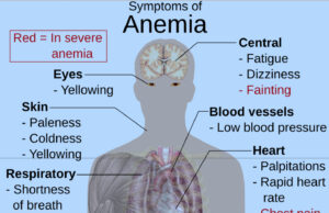 The New Old Age: Maybe It’s Not Just Aging. Maybe It’s Anemia/Tal vez no es la edad, quizás tienes anemia Symptoms of anemia (Photo courtesy Wikimedia Commons)