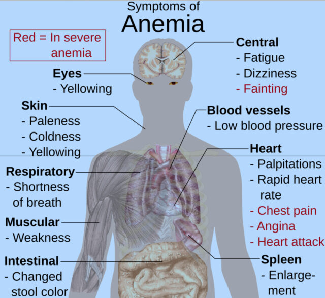 Symptoms of anemia (Photo courtesy Wikimedia Commons)