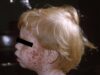 DPH confirms second positive measles case and encourages unvaccinated residents to seek vaccination (Credit photo CDC - Photo courtesy Wikimedia Commons)