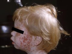 DPH confirms second positive measles case and encourages unvaccinated residents to seek vaccination (Credit photo CDC - Photo courtesy Wikimedia Commons)