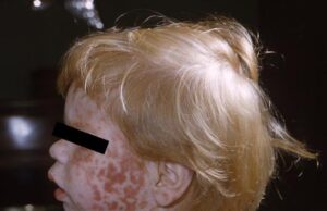 DPH confirms second positive measles case and encourages unvaccinated residents to seek vaccination (Credit photo CDC - Photo courtesy Wikimedia Commons)