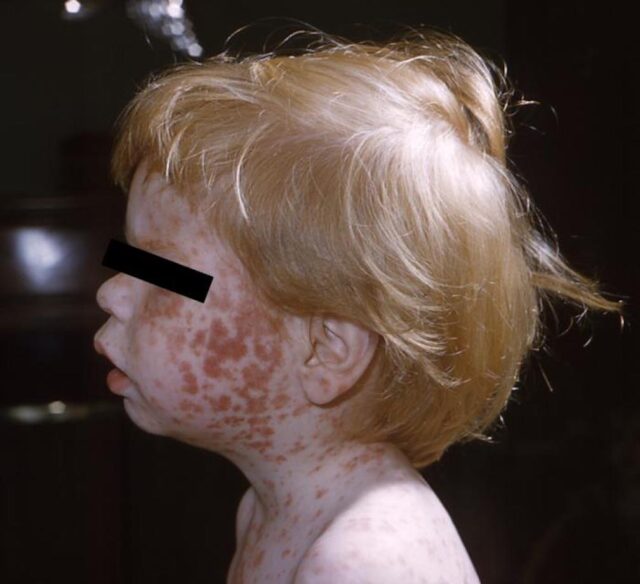 (Credit photo CDC - Photo courtesy Wikimedia Commons)